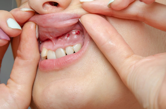 Close-up of gum with cyst or purulent flux. Disease of the gums and teeth.