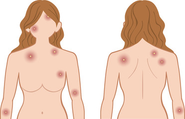 化膿　上半身　女性