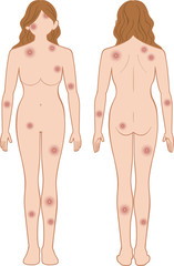 Fototapeta premium 化膿 全身 女性