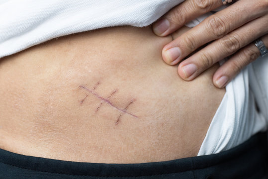 Scar of appendix pain and appendicitis inflammation disease close up 