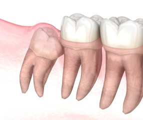 Mesial impaction of Wisdom tooth. Medically accurate tooth 3D illustration