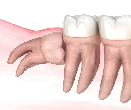 Horizontal impaction of Wisdom tooth. Medically accurate tooth 3D illustration