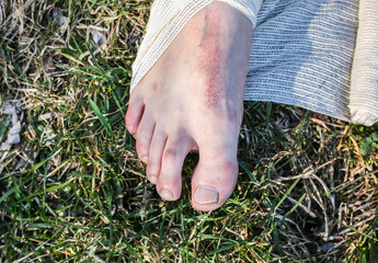 Man is putting bandage on sprained ankle. Twisted leg. Person sitting in the nature. Barefoot on...