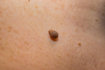 Papilloma on a woman's skin. Macro,soft focus.
