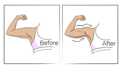 Female biceps and triceps before and after sport. Arms showing progress after fitness. Bent arm with bat wing vs well toned arm. Vector illustration for beauty, sport or medicine infographic.