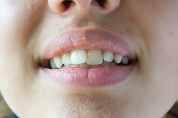 Crooked teeth of a young girl close-up.