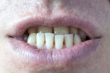 Crooked teeth of a man close-up.