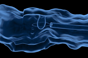 endoscope remove colonic polyp