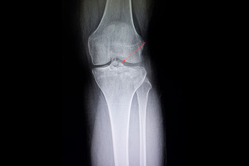 fracture tibial spine film