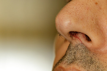 Protruding nose hairs on a man