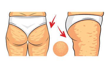 Color vector illustration of cellulite problem. Female hips rear view and side view. Fat deposits on the female buttocks. Hip with orange peel macro view