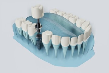 Component of Dental implants. Blue color transparent  3D rendering illustration.