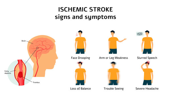 Ischemic stroke signs and symptoms infographic flat vector illustration isolated.