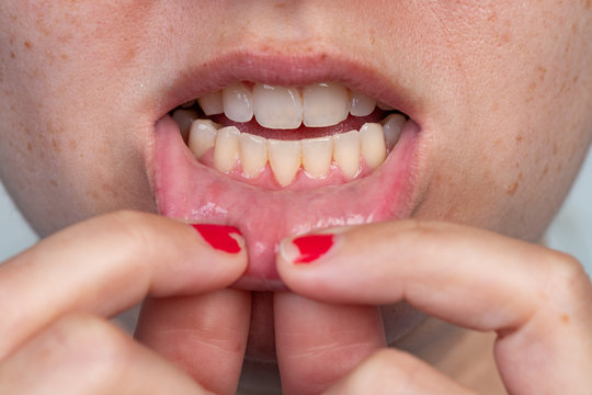 Gum Recession After A Frenectomy