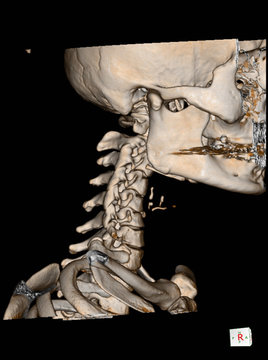 CT Scan Cervical Spine 3 D Render And X-ray C-spine Finding Reverse Cervical Lordosis Thoracic Scoliosis With Cervical Spondylosis.