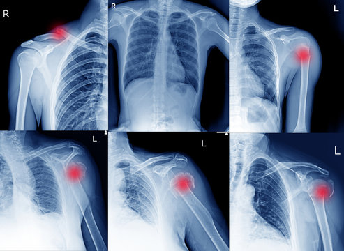 Collection Film x ray shoulder radiograph show shoulder dislocation and bone broken (neck of humerus fracture) from accident Highlight on arrow point. Medical imaging concept.
