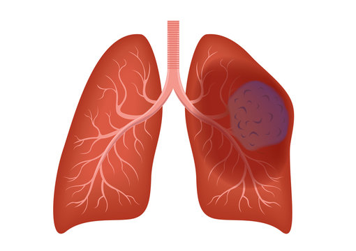 lung cancer anatomy vector / organ