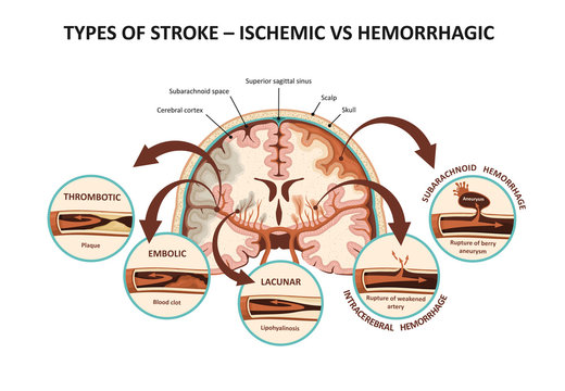Types of stroke – ischemic vs hemorrhagic