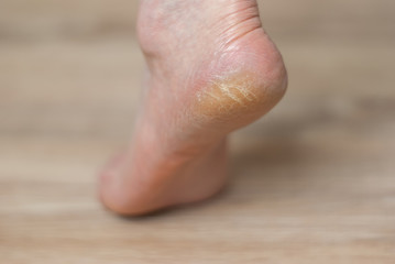 clavus and cracks on the heel of the foot