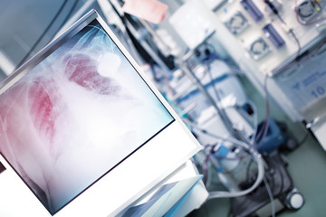 X-ray of lungs on the background of advanced equipped hospital room with patient in the bed