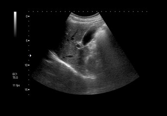 Black and white Ultrasound image of woman stomach (upper abdomen) for medical diagnosis.