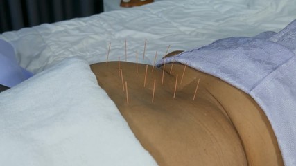 Close-up of senior female back with steel needles during procedure of the acupuncture therapy