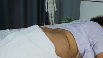 Close-up of senior female back with steel needles during procedure of the acupuncture therapy