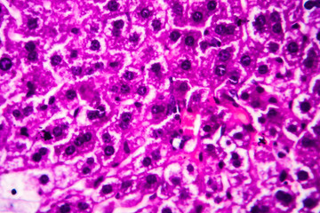 Histopathology of acute hepatitis, light micrograph, photo under microscope. High magnification