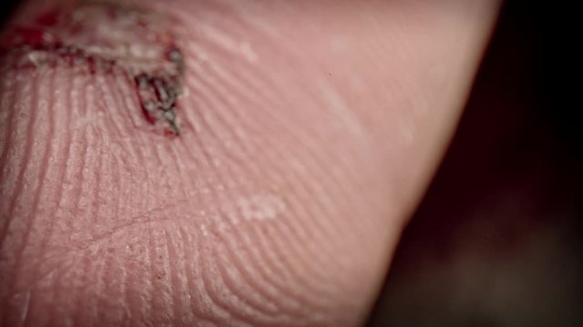 4k Close-up Shot of Man Finger with a Wound