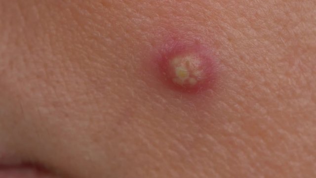 Closeup view of big ugly red and white pimple on skin of face of white woman. Facial skin problems concept. Real time 4k video footage.