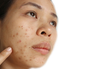Asian woman Facial skin with acne and scars Caused by hormones during adolescence.