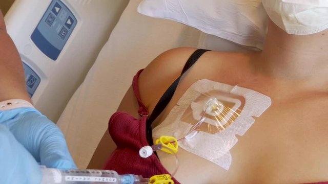 Nurse drawing blood from a central venous catheter port in a syringe with saline
