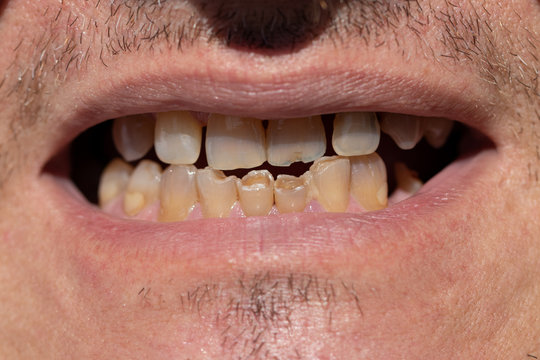 Damaged front teeth, chips, cracks, fillings. Close-up of bad ad