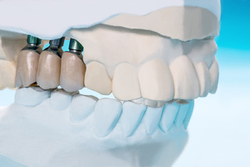Close up Implant model tooth support fix bridge implant and crown.