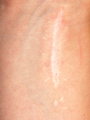 Close-up of arm with old scar,  scars, surgical scar on the skin