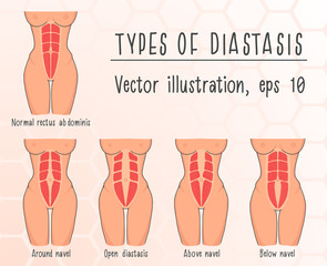 Vector illustration of the types of diastasis