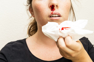 Wound nosebleed, woman bleeding from her nose, nose injury blood and tissue