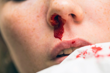 Wound nosebleed, woman bleeding from her nose, nose injury blood and tissue