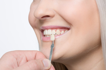 Using shade guide at mouth to check veneer of teeth for bleaching
