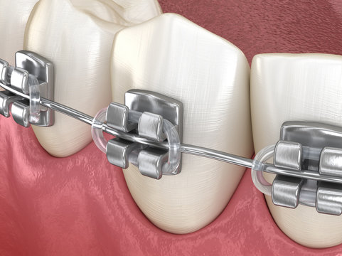 Healthy Teeth with metal braces, Macro view. Medically accurate dental 3D illustration