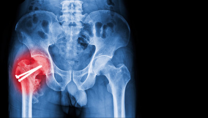 Hip fracture Repair. Shown is a fracture of the femoral neck that was repaired with multiple...