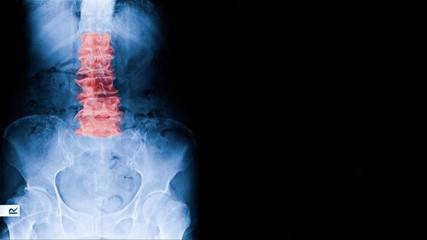 X-ray image elderly people have low back pain X-ray show lumbar spine spondylosis means degenerative changes of spine in old age. - obrazy, fototapety, plakaty