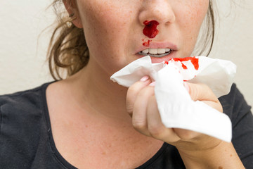 Wound nosebleed, woman bleeding from her nose, nose injury blood and tissue