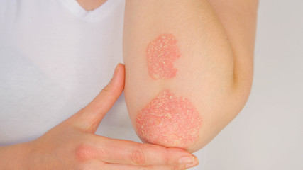 CLOSE UP Woman with big red scaly rash suffering from elbow psoriatic arthritis