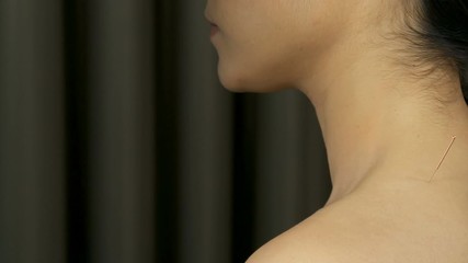 young woman undergoing acupuncture treatment on shoulder