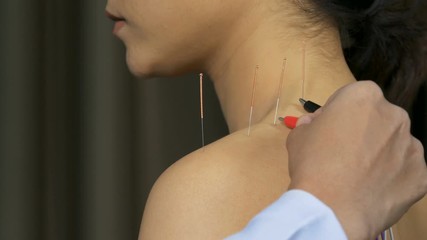 young woman undergoing acupuncture treatment with electrical stimulator on shoulder