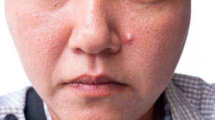 Closeup of red skin with acnes