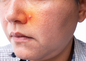Closeup of red skin with acnes