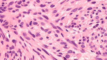 Microscopic image of a leiomyosarcoma, a type of soft tissue sarcoma of smooth muscle.  This malignant tumor typically occurs in the uterus or GI tract, but can occur from blood vessels elsewhere. 