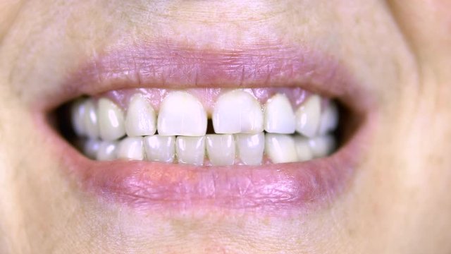 Old woman shows teeth. The upper teeth are straight and the lower crooked. close-up